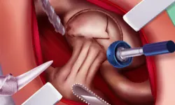 Princess Hips Surgery
